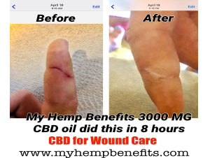 CBD for Wound Care
